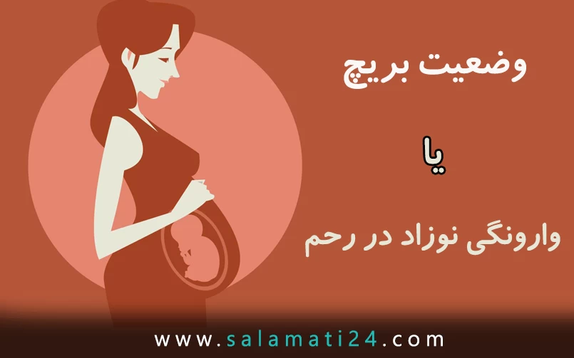 وضعیت بریچ یا وارونگی نوزاد در رحم