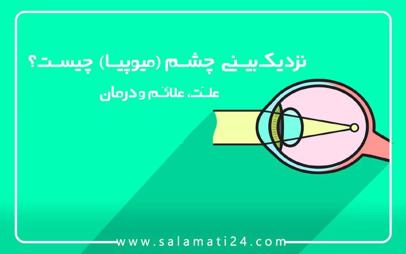 نزدیک بینی چشم (میوپیا) چیست ؟ علت، علائم و درمان