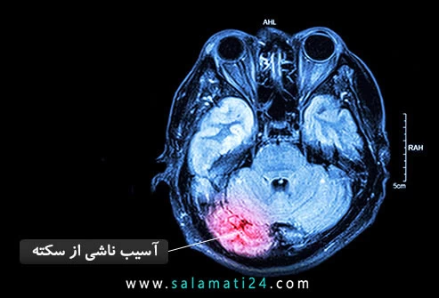 سکته مغزی