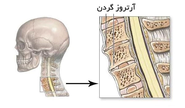 آرتروز گردن