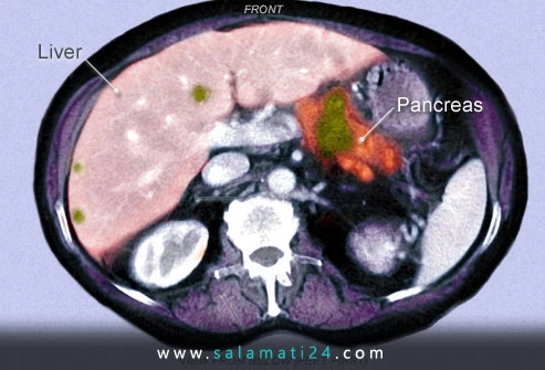 تشخیص سرطان پانکراس