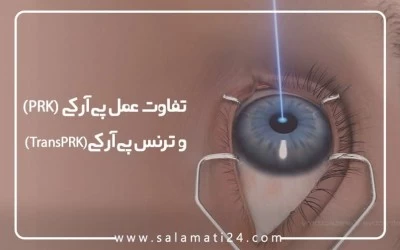 تفاوت جراحی عمل پی آر کی (PRK) و ترنس پی آر کی (TransPRK)