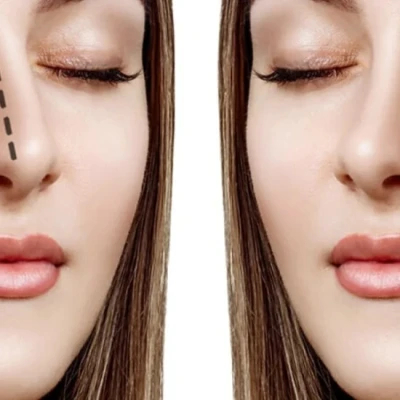 آیا عمل بینی بدون بیهوشی واقعاً موثر است؟ پاسخ متخصصان زیبایی و زیباجویان