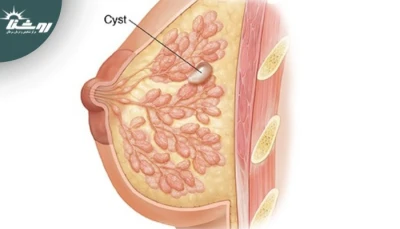 آیا مصرف کافئین باعث ایجاد کیست‌های پستان می‌شود؟