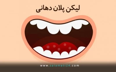 لیکن پلان دهانی (Oral lichen planus)