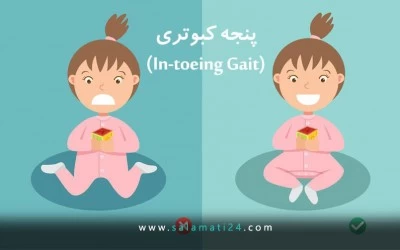 In-toeing Gait (پای پنجه کبوتری)