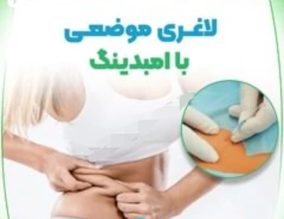 لاغری با امبدینگ طب سوزنی