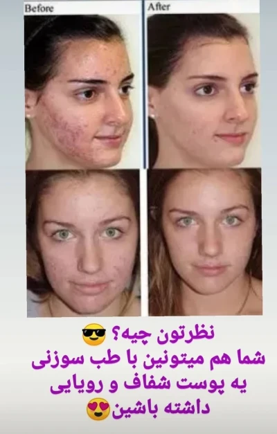 درمان بعد طب سوزنی