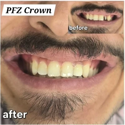 روکش PFZ
