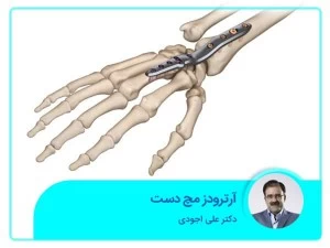 آرترودز مچ دست 