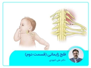 فلج زایمانی. قسمت دوم