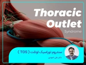 سندروم توراسیک اوتلت (  TOS  )