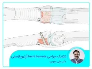 تکنیک جراحی hemi hamate آرتروپلاستی