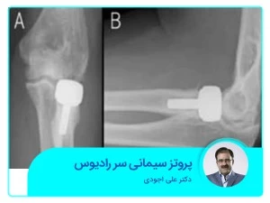 پروتز سیمانی سر رادیوس