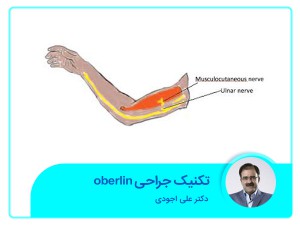 تقنية الجراحة أوبرلين