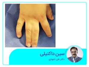 سین داکتیلی یا چسبندگی مادرزادری انگشتان دست