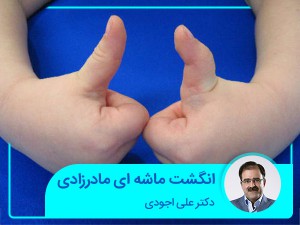 انگشت ماشه ای در اطفال