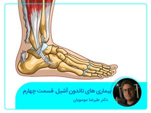 أمراض وتر العرقوب. الجزء الرابع